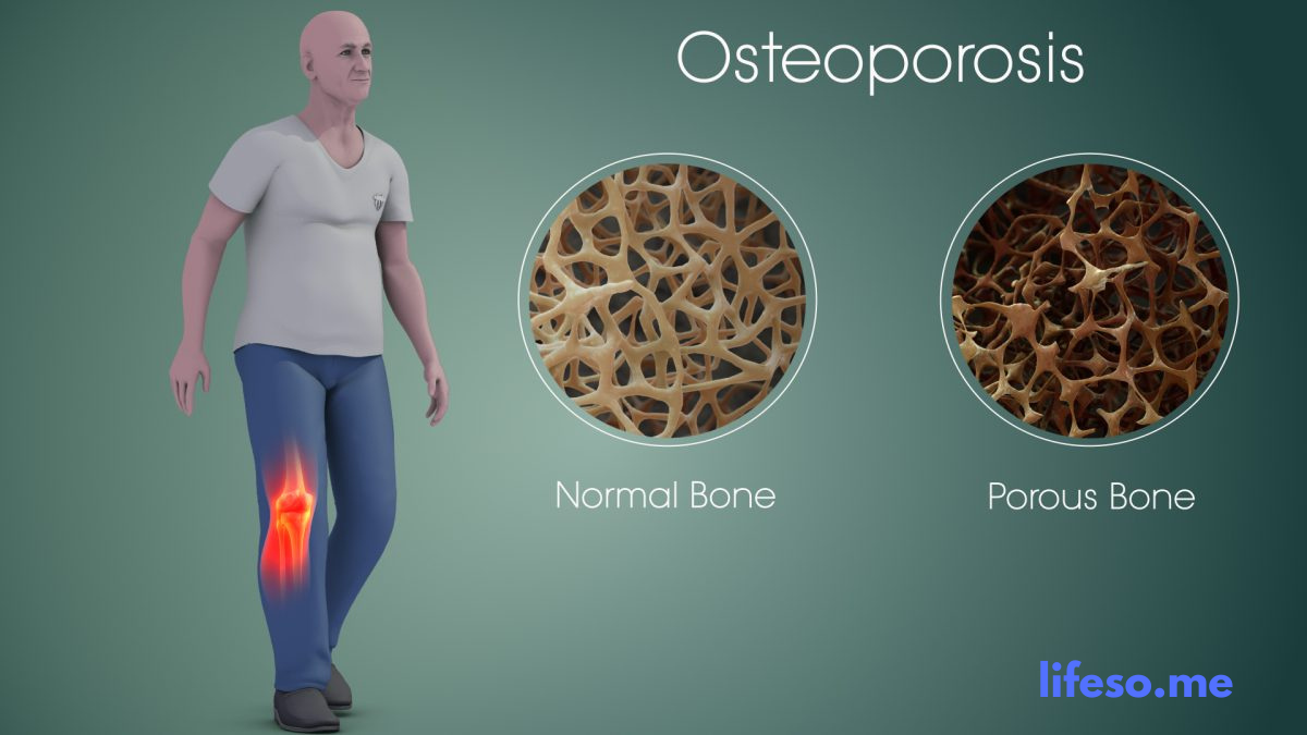 : Cara Mencegahan Osteoporosis Sejak Usia Muda dan Bagaimana Ciri-Ciri nya?