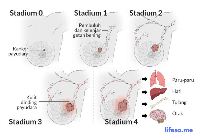 Sebab Akibat Terjadi Nya Kanker Payudara Dan Cara Menanganinya