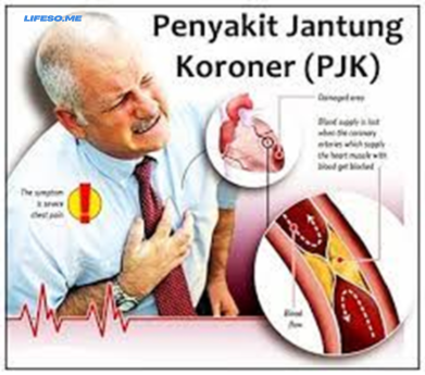 Penyakit Jantung Kronis: Penyebab dan Cara Menghindarinya